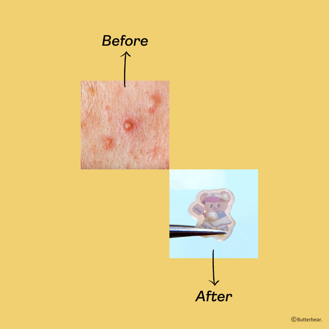 【Yukazan x Butterbear】 Hydrocolloid Acne Healing Patch 30's Pimple Patch